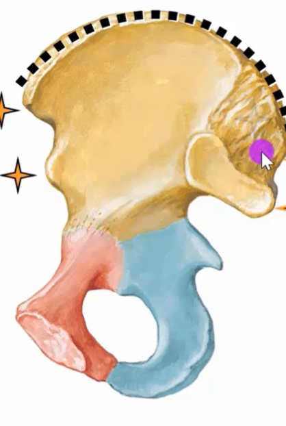 The image shows a detailed illustration of a pelvis with a fracture, specifically a type of acetabular fracture. The pelvis is depicted in a lateral view, with the ilium bone colored in yellow, the ischium in red, and the pubis in blue. A dotted line indicates the fracture site, and a cursor hovers over a small area on the ilium. Two orange stars are visible on the left side of the image. The background is white.