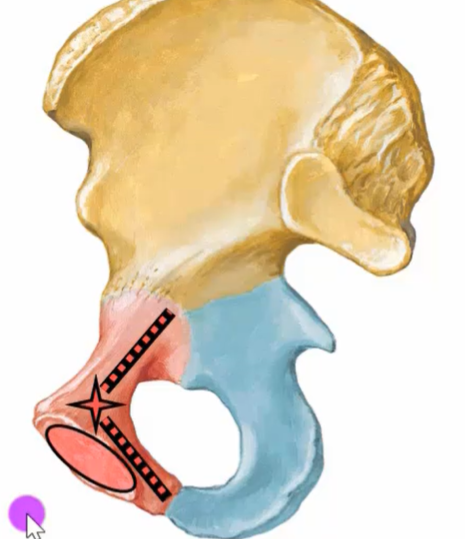 The image depicts a medical illustration of a pelvis with a surgical site marked.