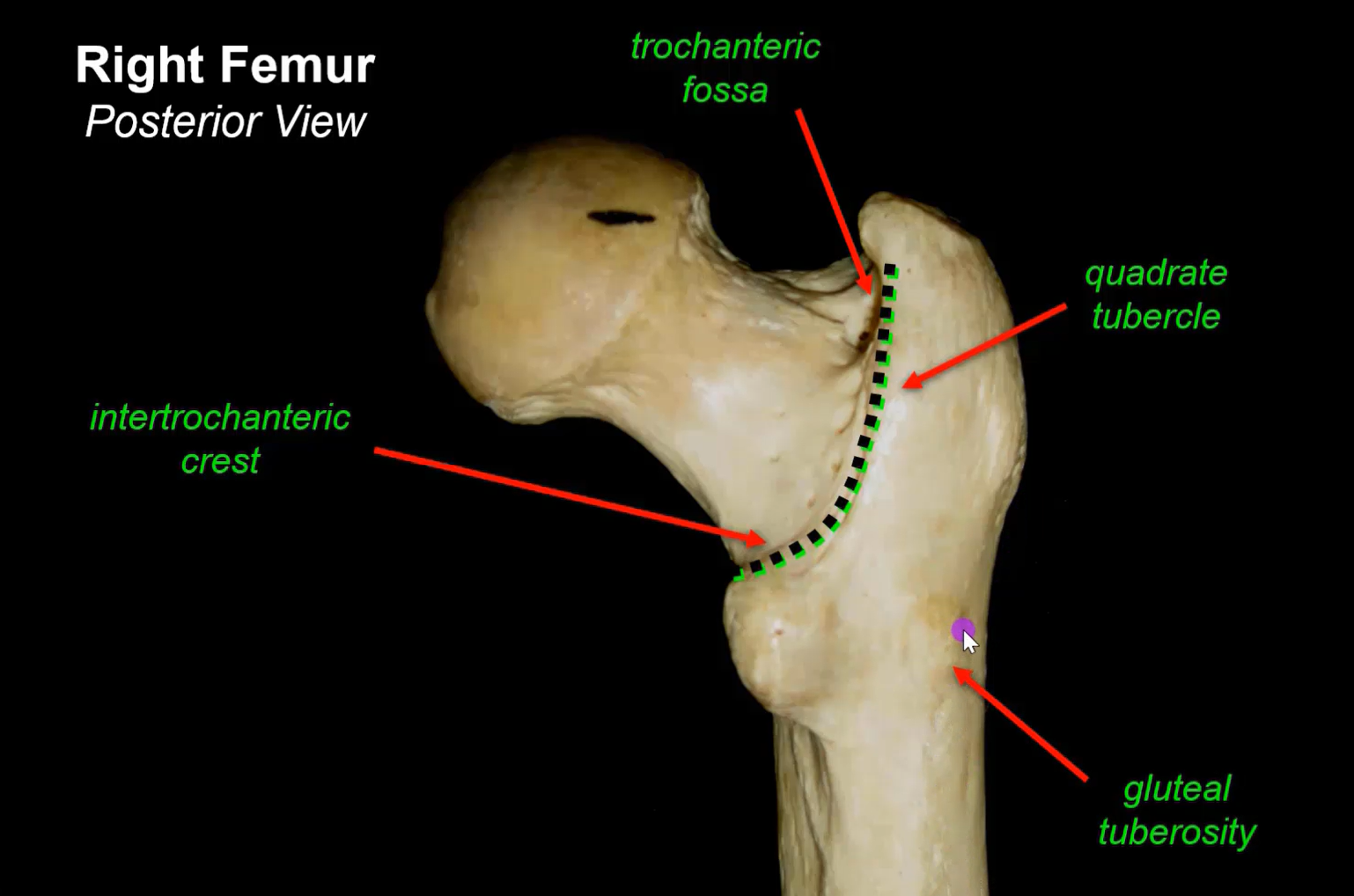 The image shows a posterior view of a right femur with labeled anatomical features. The femur is shown against a black background. The labels include the trochanteric fossa, intertrochanteric crest, gluteal tuberosity, and the quadratic tubercle.